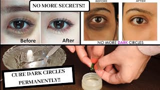 How to remove dark circles PERMANENTLY | My secret revealed | Shivali Dewan