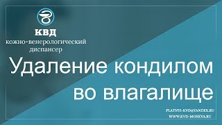 633  Удаление кондилом во влагалище