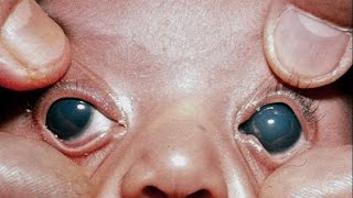 Проверка зрения новорожденного, Глаукома, Причины, Лечение © Newborn's eyesight check, Glaucoma