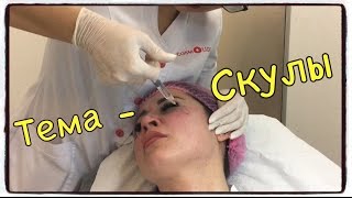 Увеличение СКУЛ ФИЛЛЕРАМИ. Коррекция скул. Убираем носогубку.