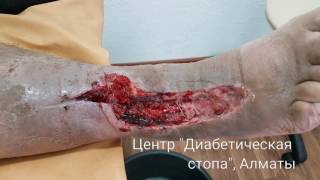 Лечение газовой гангрены при диабете