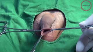 ShangRing - Non-Flip Circumcision Surgery with Topical Anesthesia