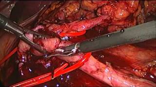 LAPAROSCOPIC LEFT PYELOPLASTY-ΛΑΠΑΡΟΣΚΟΠΙΚΗ ΠΥΕΛΟΠΛΑΣΤΙΚΗ