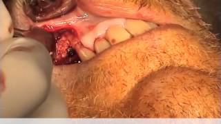 Implant avec greffe vestibulaire