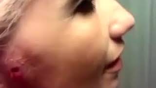 Слабонервным не смотреть!ШОК! Личинка овода в щеке!Ужас!