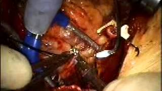 MICS CABG, Minimally Invasive Coronary Surgery