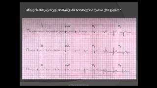 ეკგ გარჩევა. I ხარისხის ატრიოვენტრიკულური ბლოკადა (AV-ბლოკადა)