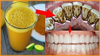 দাঁতের মধ্যে লেগে থাকা ময়লা কালো ও হলুদ দাগ থেকে মাত্র ১ মিনিটে মুক্তি | দাঁত ঝকঝকে সাদা করার উপায়