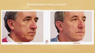 Rejuvenecimiento Facial Inmediato sin Cirugia con Hilos Absorbibles: Fotos y Ventajas