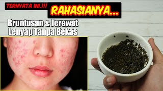 TAK USAH PERAWATAN SALON, BRUNTUSAN BAHKAN JUGA JERAWAT HILANG TOTAL DENGAN RACIKAN MUJARAB INI