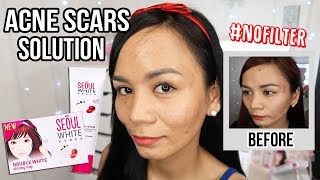 GOODBYE ACNE SCARS! (Seoul White Korea Review) | RealAsianBeauty Acne