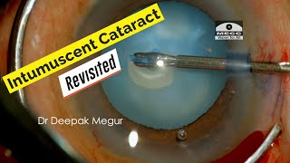 Intumuscent Cataract Revisited..! Dr Deepak Megur