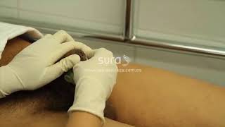 Cateterismo vesical Intermitente