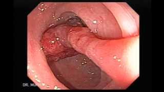 Endoscopia de Pólipo Pediculado Polipectomía