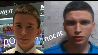 Отостик Otostick - эстетический корректор лопоухости. Отзыв реального пользователя