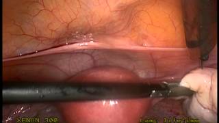 Pelvic Pain,  Diagnostic Laparoscopy, Endometriosis, PCOS, Virgin,