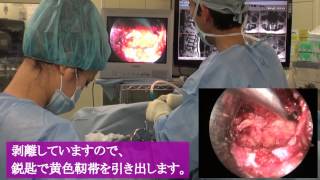 腰部脊柱管狭窄症(MEL) 手術と症例解説【岩井整形外科内科病院】