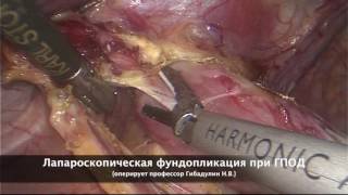 Лапароскопическая фундопликация при грыже пищеводного отверстия диафрагмы