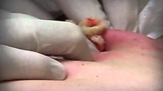 BIGGEST CYST ON THE PLANET  |  Operation "Kill George"
