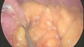 Продольная резекция желудка sleeve gastrectomy + задняя крурорафия