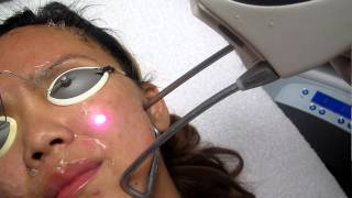 Acne Treatment-Irvine-Brea-Orange-Los Angeles-Anaheim-Burbank-Pasadena