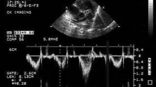 Pulmonary Stenosis