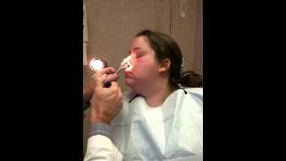 SEPTOPLASTY Splint Removal