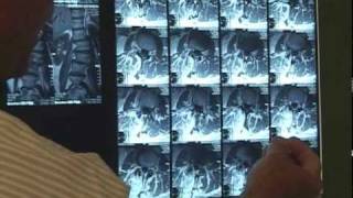 Interview with Dr. G. Clay Baynham at Palm Beach Orthopaedic Institute