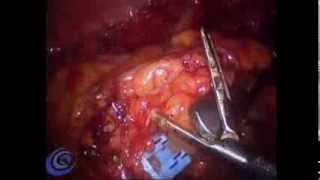 NOTES SURGERY, TRANSVAGINAL, CSPA