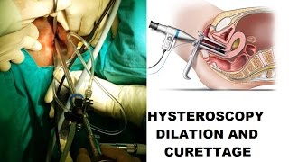 HYSTEROSCOPY DILATION AND CURRETAGE