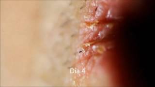 1 semana con herpes