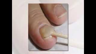 Nail Fungus Guide How To Get Rid of Nail Fungus
