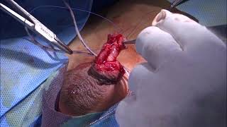Dr Sagar Jawale's Urethral Pull Up Operation