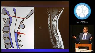 2019 ASAP Conference: Chiari Surgery Failures, G Grant, MD