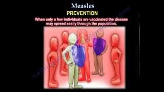 Measles  - Everything You Need To Know - Dr. Nabil Ebraheim