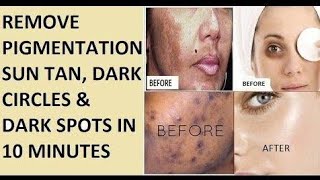 झाइयां खत्म करने का तरीका/ Pigmentation की परेशानी है तो ये क्रीम आपके लिए है|| #jhaiyakhatmkrneka