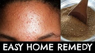 Get rid of Pimples and Acne NATURALLY | AYURVEDIC Remedy