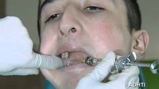 мандибулярное анестезия по фишеру...mandibular anesthesia Fischer