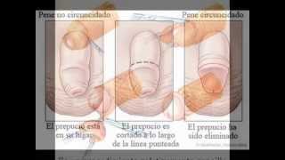 Fimosis y Circunsición. Urología Peruana. Dr. Susaníbar