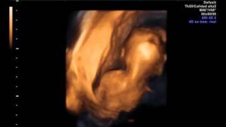 Ecografia 4D embarazo de  19 semanas  Clinica Ginecologica Dr. Rafael Ortega Muñoz Ciudad Real
