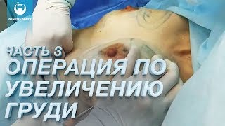 Операция по увеличению груди у Сергей Хаустов. Пластическая хирургия в Клинике GENESIS DNEPR Часть 3