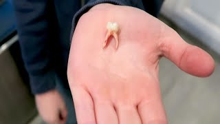 WORLDS LARGEST TOOTH EXTRACTION