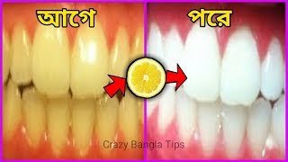 মাত্র ১ বারে হলদে দাঁত ঝকঝকে সাদা করার উপায়।দাত সাদা করার ঘরোয়া উপায়।