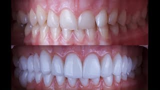 Керамические виниры. Наша работа. Стоматология Улыбка. Одесса