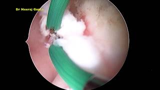 Vaginal vertical septum resection with uterus didelphys