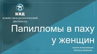 626  Папилломы в паху у женщин