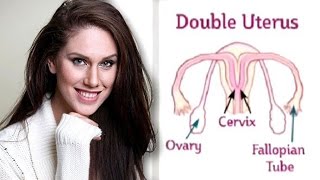 Uterus Didelphys - Meet The Woman With The Double Uterus