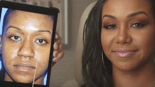 Ethnic Rhinoplasty Before and After Transformation Patient Story