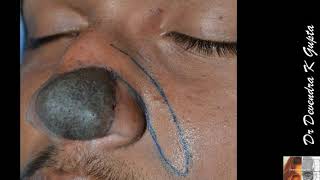 2 Congenital pigmented or melanocytic nevus: Giant Mole Tip of the Nose