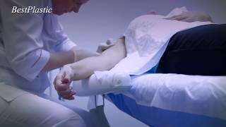 Инновационная подтяжка кожи - 3D мезонити
